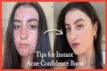 How To Feel Confident With Acne?